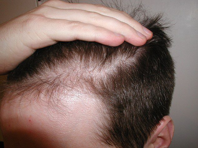 Male Pattern Hair Loss Problem Concept Young Man Losing Hair On Temples  Close Up Space For Text Baldness Alopecia In Males Stock Photo - Download  Image Now - iStock