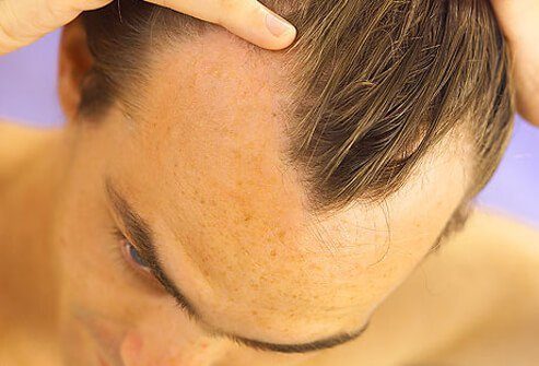 hair scalp s8 male hair loss