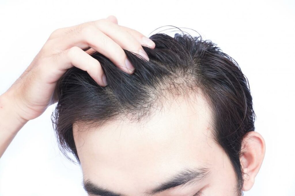vitamin d deficiency can lead to hair loss