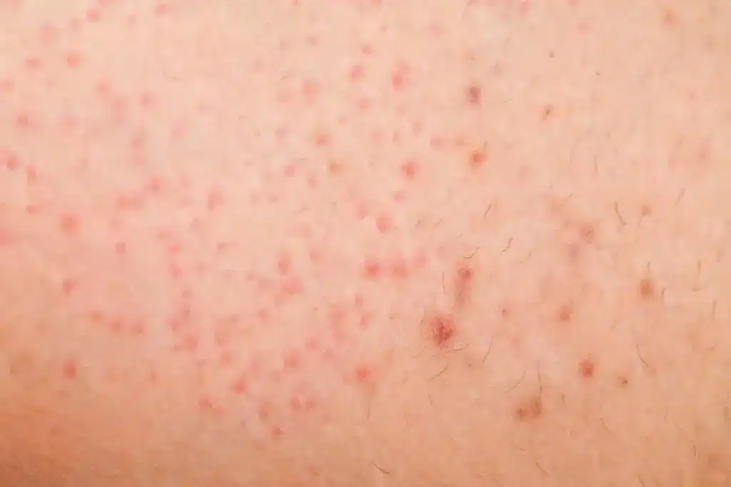 folliculitis which may be a sign of being itchy after shaving 1