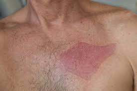 treat-chemical-burn-from-hair-removal-cream